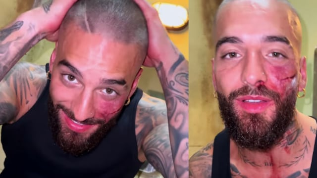 Maluma reaparece golpeado y pelón