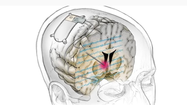Dispositivo Depresión