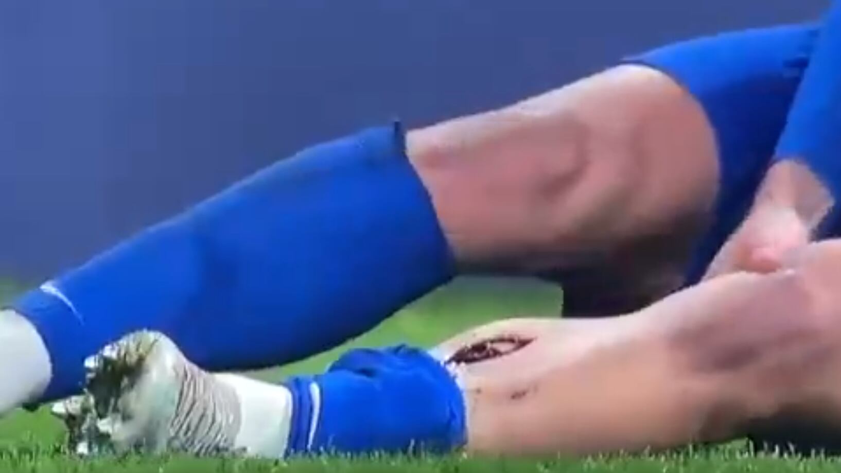 La brutal lesión de un jugador y todo por la moda de ponerse micro espinilleras