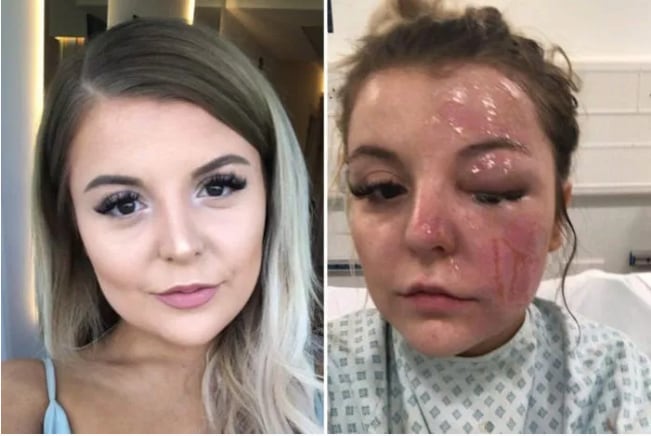 Bethany Roose todavía no sabe si la ceguera es temporal o permanente