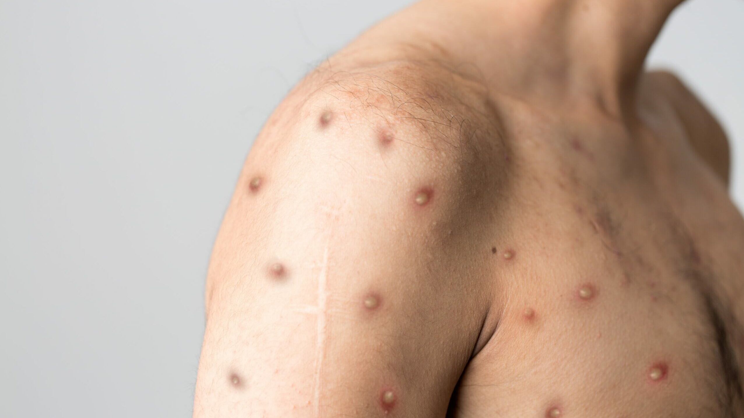 ¿Qué es la viruela del mono, mpox? La rara enfermedad viral por la que OMS decretó emergencia mundial en 2024