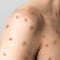 ¿Qué es la viruela del mono, mpox? La rara enfermedad viral por la que OMS decretó emergencia mundial en 2024