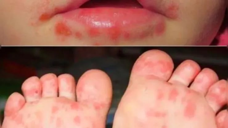 ¿Qué es la gripe del tomate, una enfermedad contagiosa y rara que afecta a niños y niñas?