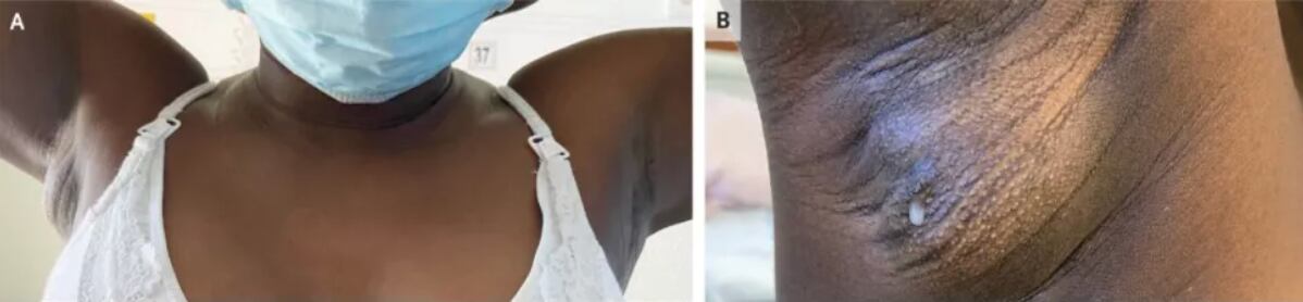 Mujer secreta leche materna por la axila