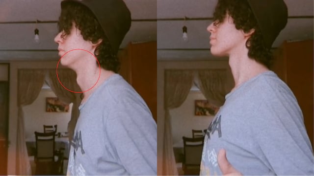 Mewing, antes y después