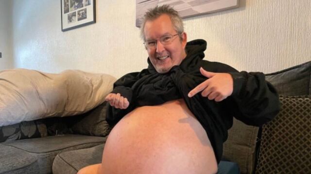 Hombre con los riñones más grandes del mundo