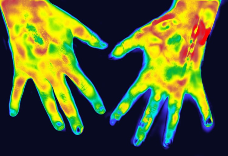 ¿Síndrome de Sudeck se cura? 11 síntomas, cómo se diagnostica y qué es