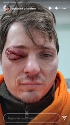 Ciervo ataca a un cazador; le saca el ojo