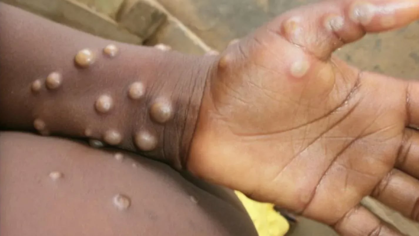 Viruela del mono, mpox: Síntomas que debes conocer para estar alerta durante 2024