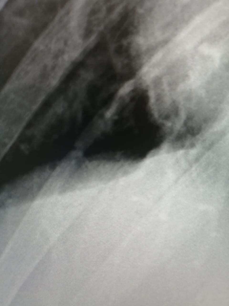 Fractura de costillas