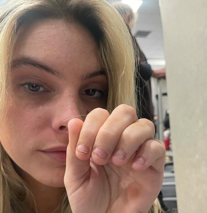Lele Pons comparte que venció su hábito de morderse las uñas