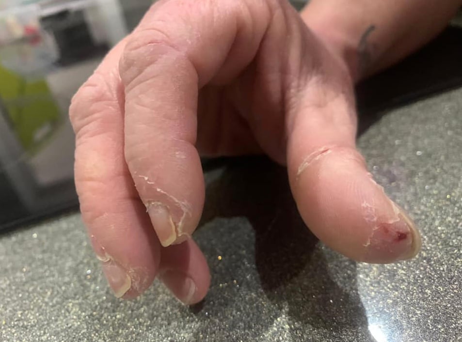 Reacción vacuna AstraZeneca