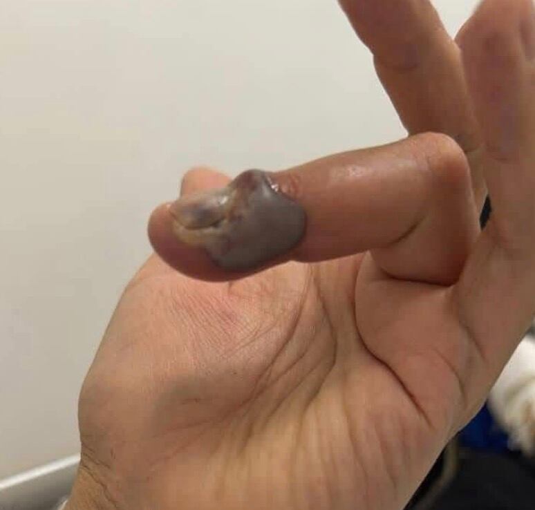 Araña violinista pica a turista en Puebla