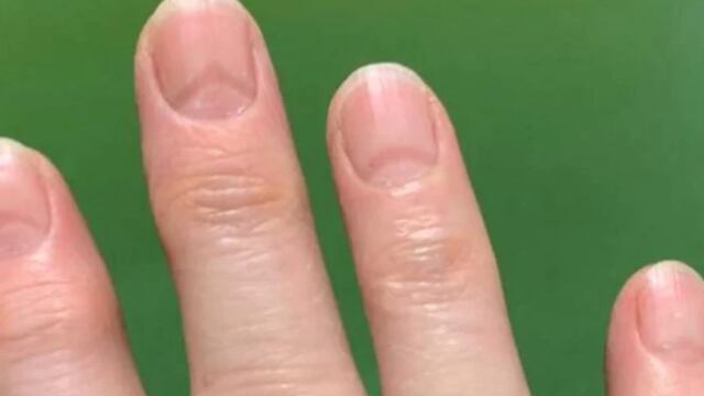 Marcas del Covid-19 en uñas