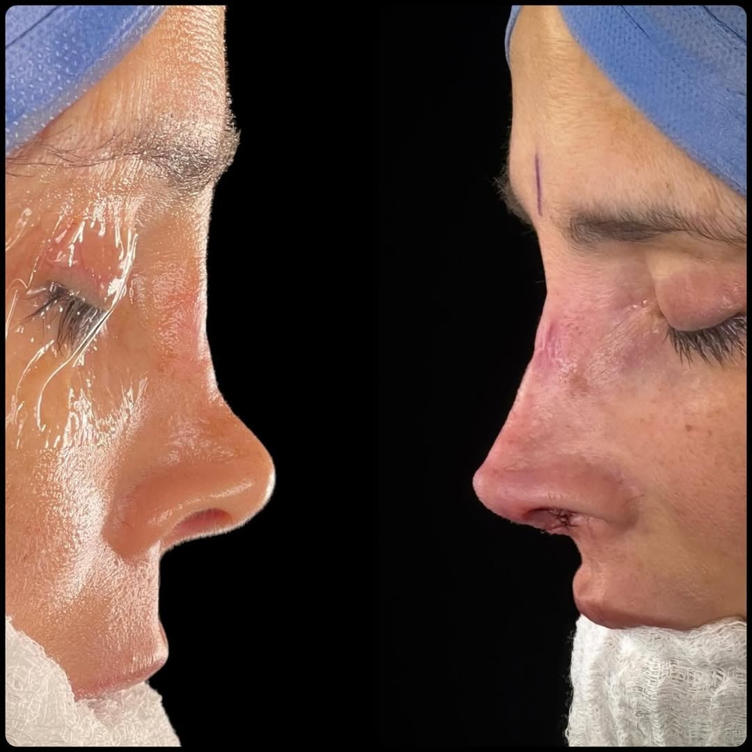 Dorismar muestra su antes y después de su cirugía de nariz