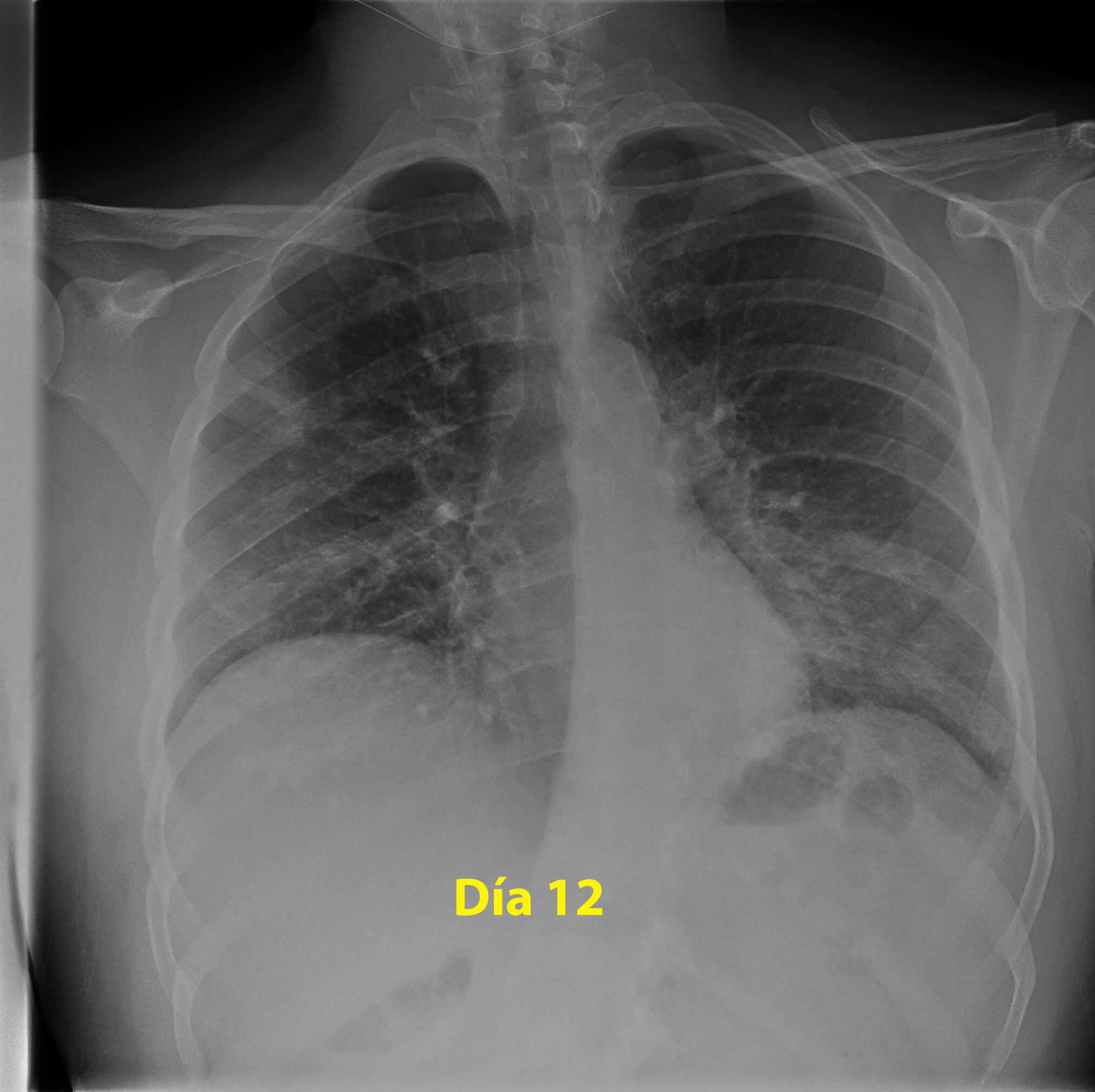 Así se ven los pulmones con coronavirus
