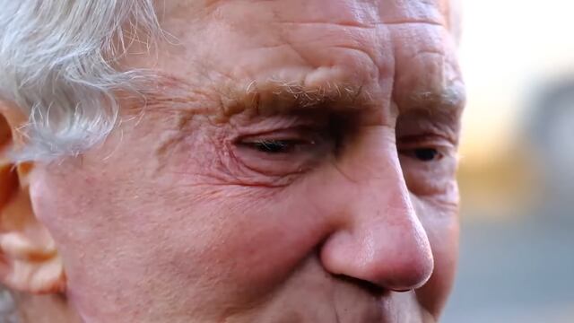 Pete Broadhurst después de la cirugía estética