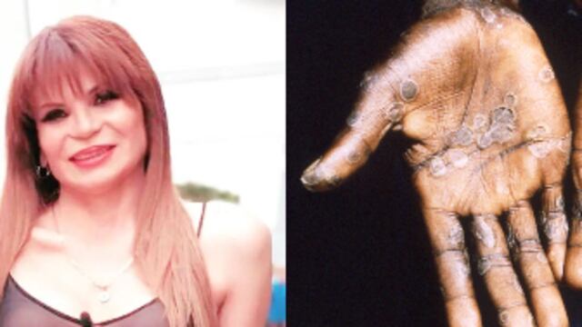 Mhoni Vidente predice que la viruela del mono será pandemia