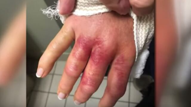 Se hace un manicure y casi pierde la mano por una bacteria come carne.