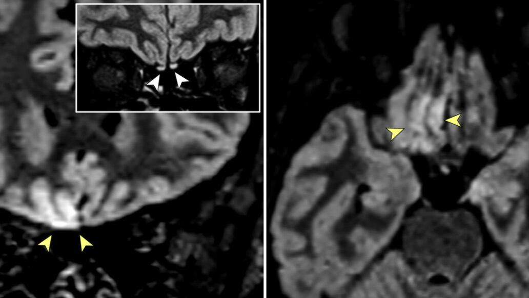 Invasión cerebral viral
