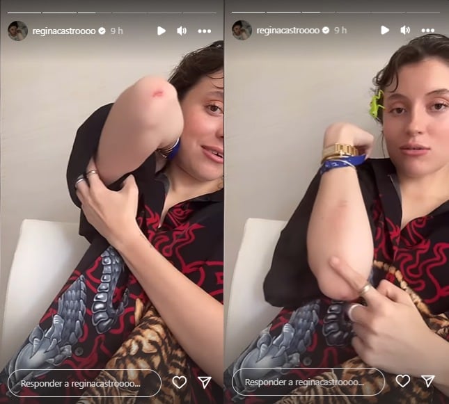 Regina Castro perdió los dientes en un accidente mientras montaba a caballo