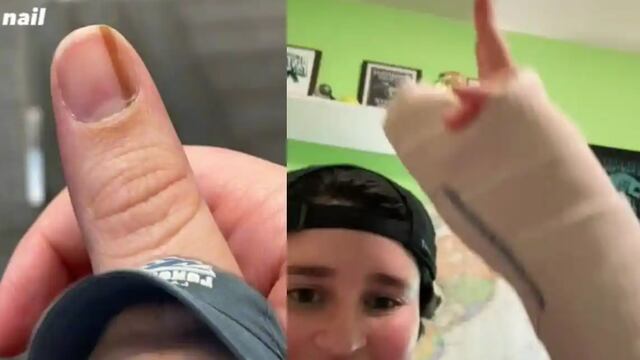 Maria Sylvia, mujer que fue al médico y se le detectó melanoma en su uña