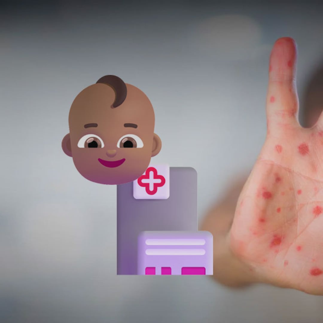 CDMX precisa edad del menor fallecido por sarampión