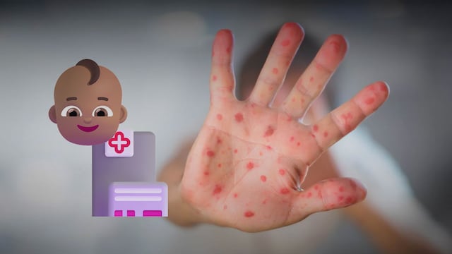 CDMX precisa edad del menor fallecido por sarampión