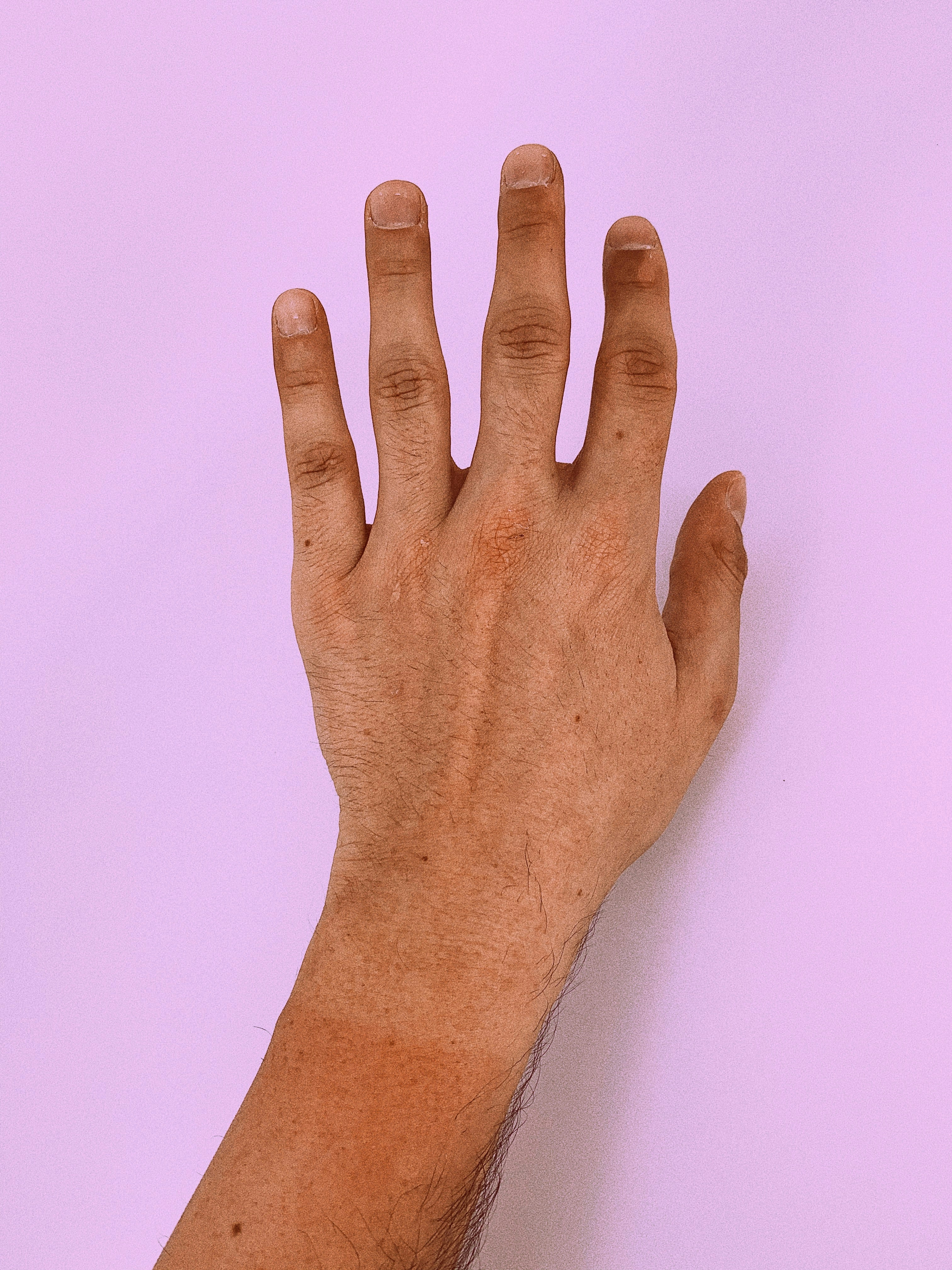 Este 23 de mayo es el Día Mundial contra el Melanoma