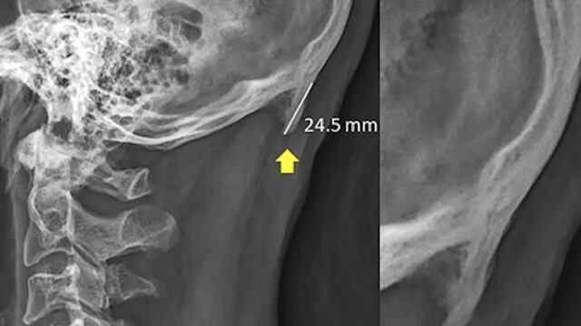 "Cuerno" en la base de un cráneo humano.