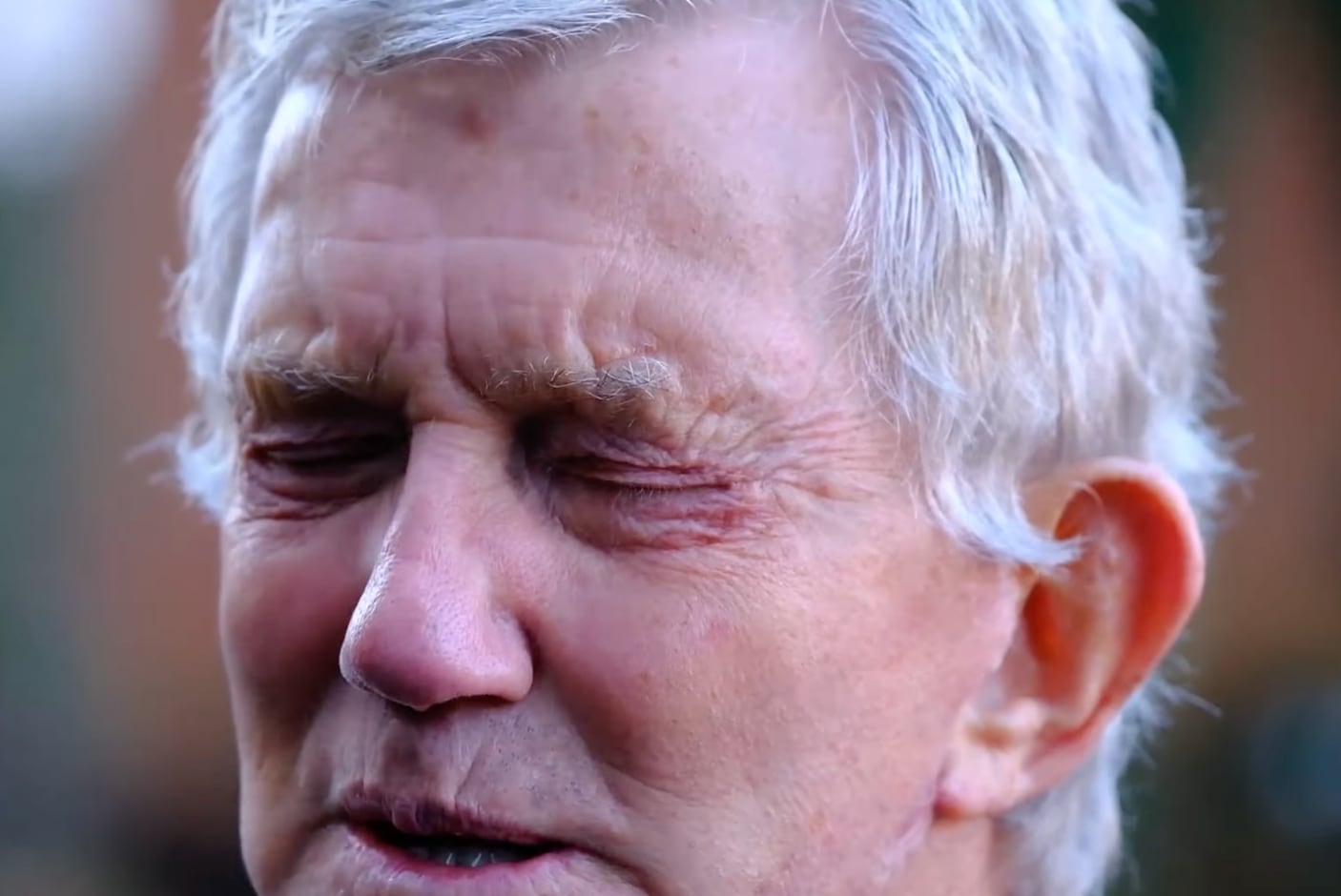 Pete Broadhurst después de la cirugía estética
