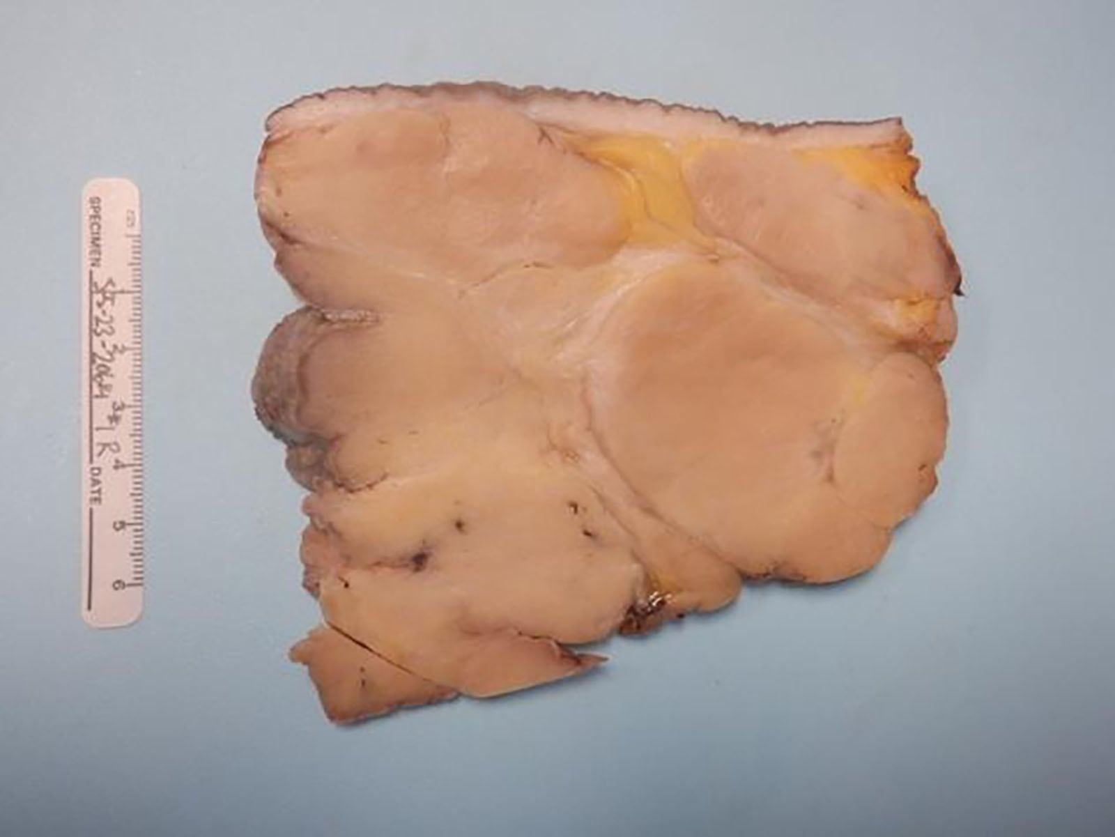 Joven con crecimiento de senos tras vacunarse contra Covid-19