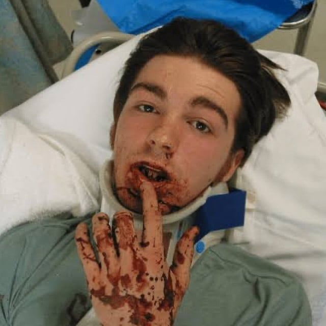 Drake Bell al momento del accidente de coche donde perdió 9 dientes.