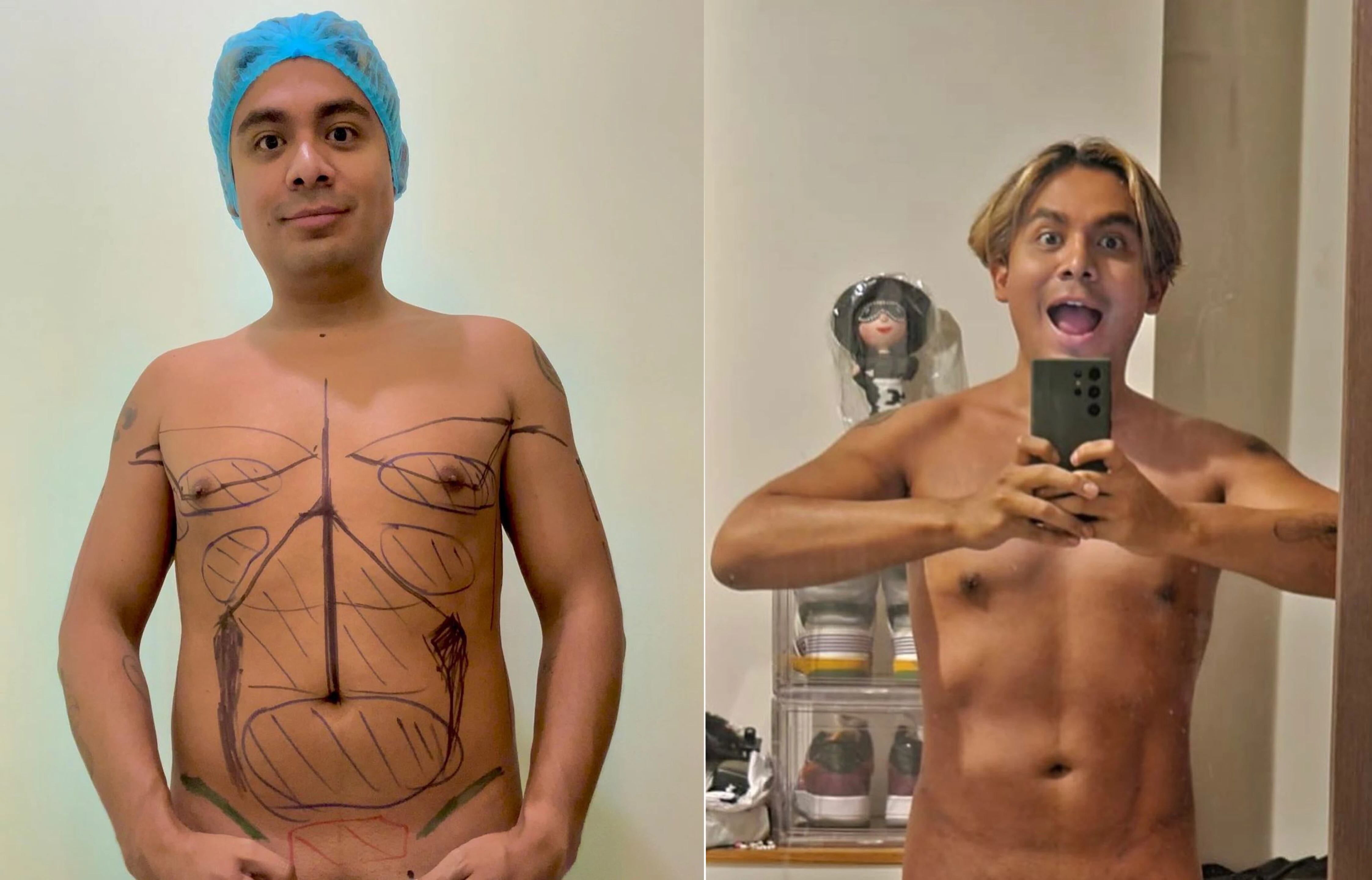 Ricardo Peralta, ganador de MasterChef Celebrity México 2022, se hizo la liposucción