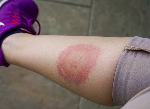 Sintomas de la Enfermedad de Lyme