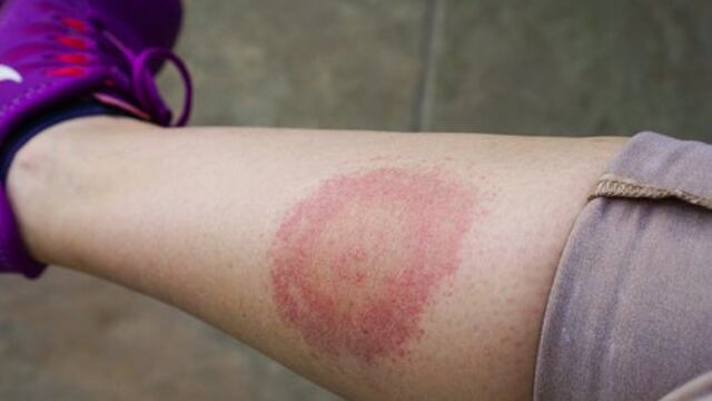 Sintomas de la Enfermedad de Lyme