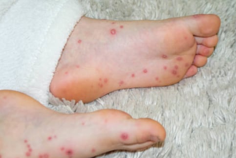 Gripe del tomate: qué es, síntomas y cómo se contagia