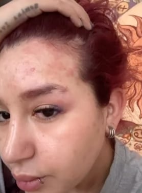 Romina Marcos tiene herpes zoster