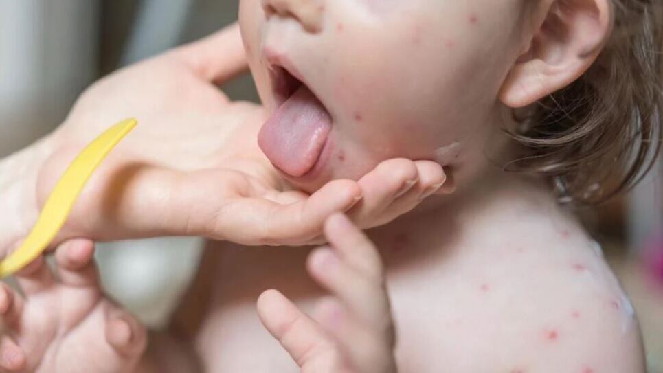 Virus Coxsackie