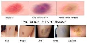 Evolución de la equimosis