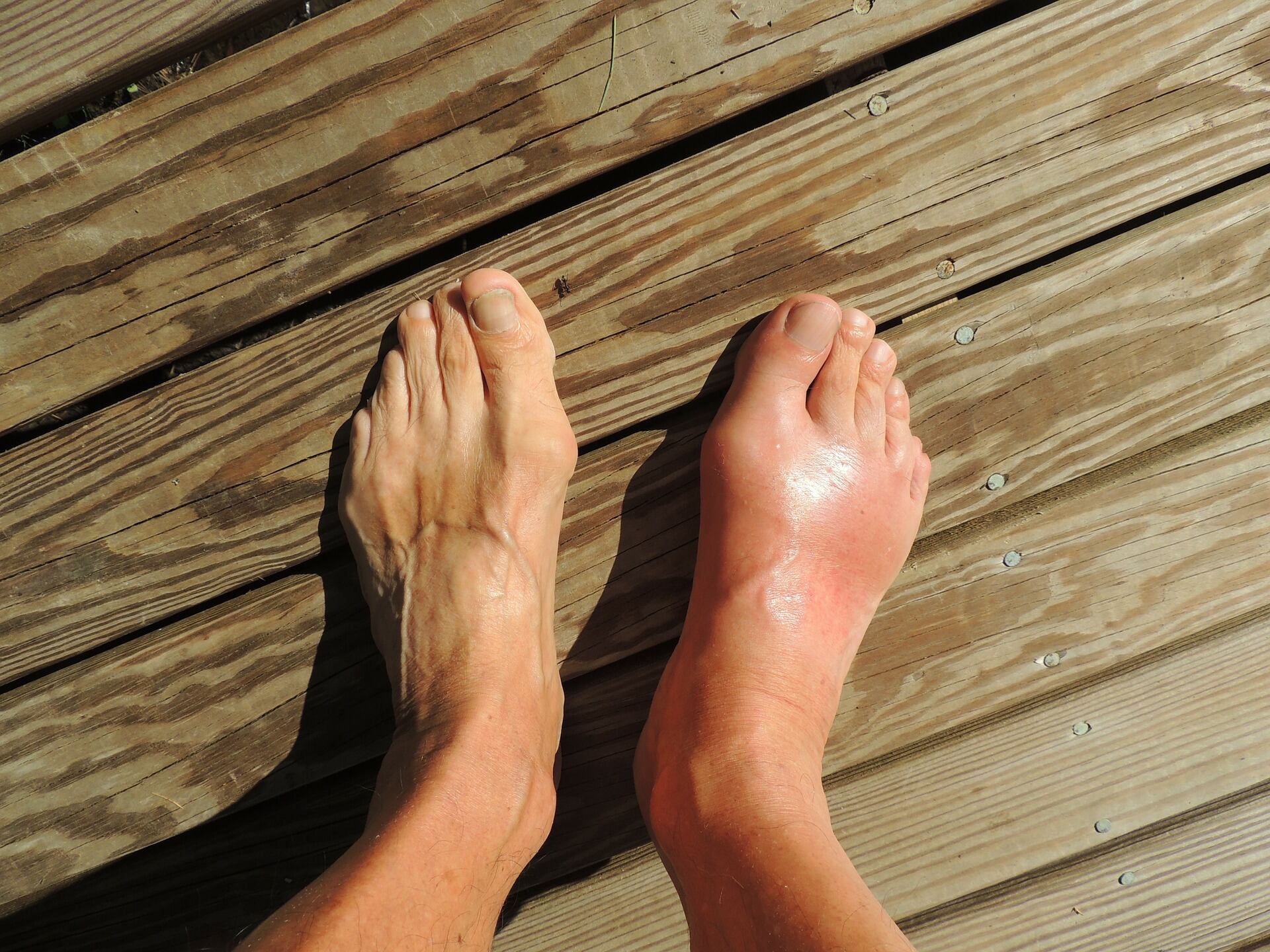 Daños en la piel de los pies