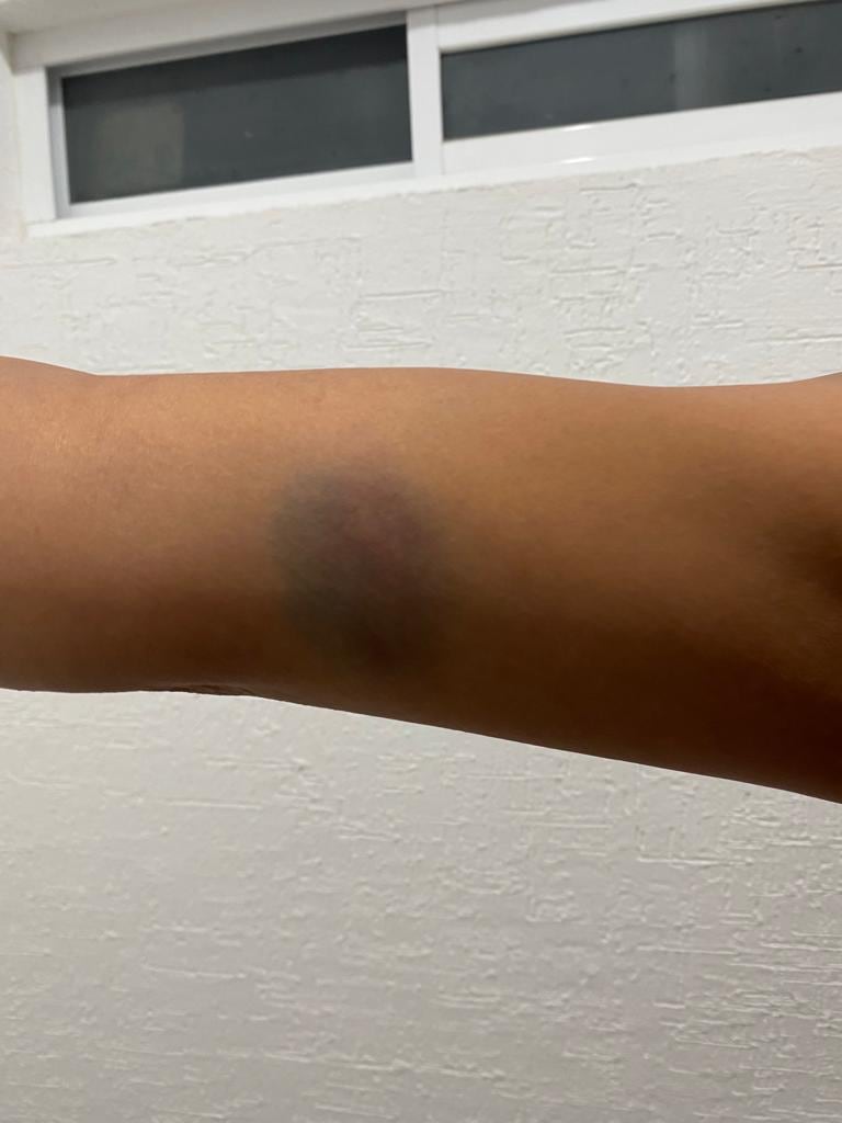 moretones y golpes a la víctima agredida en Querétaro por sus vecino/ @NiUnaMasQroFemi