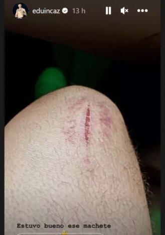 Eduin Caz se corta la pierna en el baile de los machetes