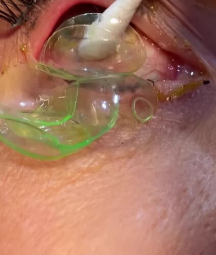 No se quitaba los lentes de contacto