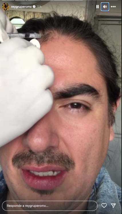 Rey Grupero padece alopecia