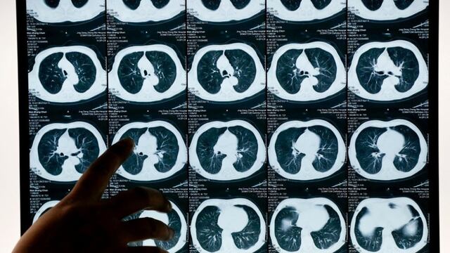 El tratamiento permite reducir el cáncer de pulmón y evitar la recaída en el 80 % de los pacientes.