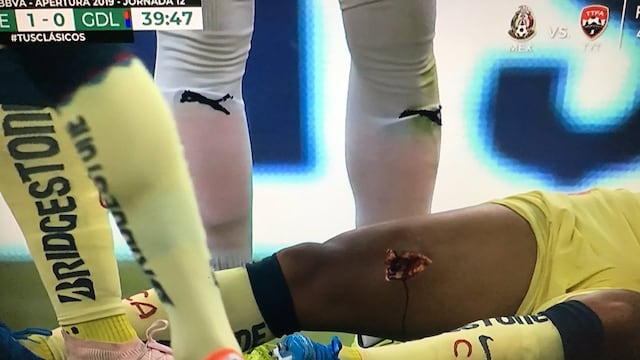 Giovani sufrió una terrible lesión en la pierna derecha