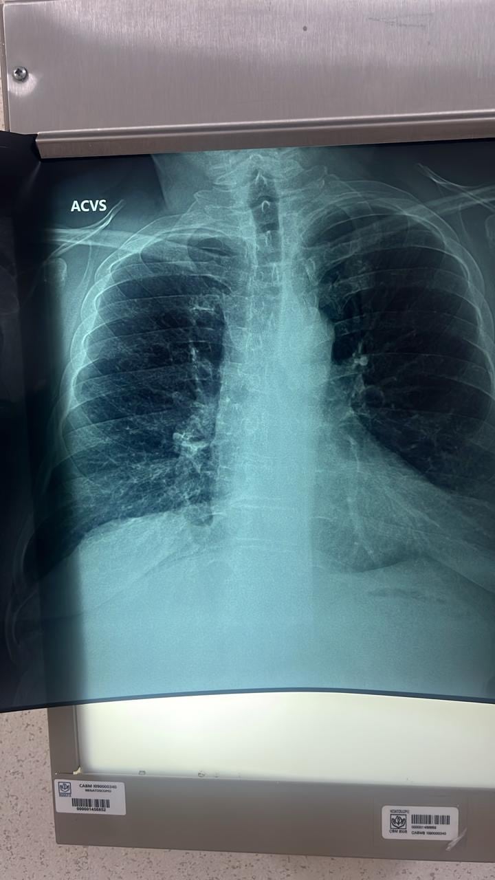 EPOC es un padecimiento que reduce el flujo del aire en los pulmones, provocando inflamación, obstrucción de bronquios