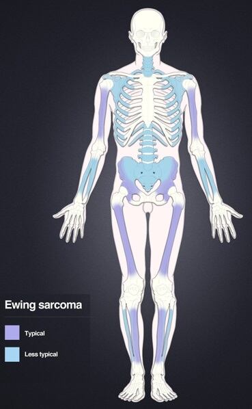 Sarcoma de Ewing