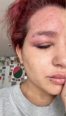 Romina Marcos tiene herpes zoster